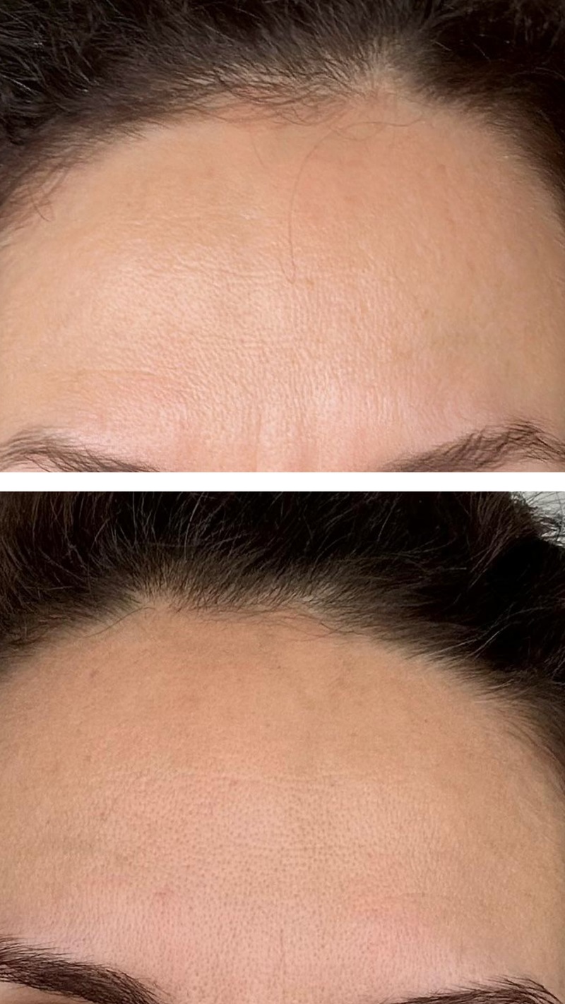Before and after comparison of a person's forehead with and without visible lines AFTER led LIGHT THERAPHY