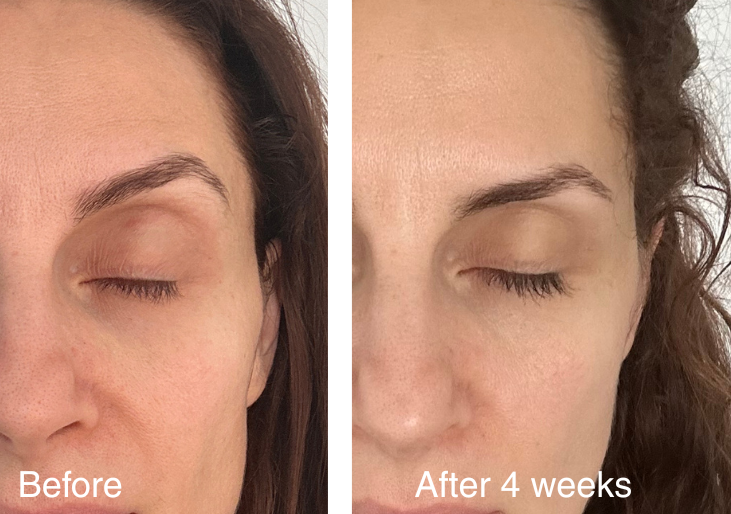 befoe and after 4 weeks with celluviv face mask 