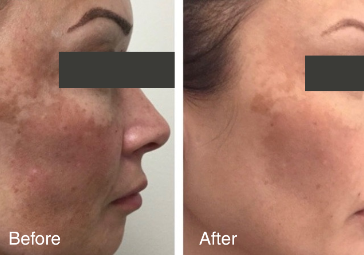 before and after LED face mask use showing brighter, smoother, and more even-looking skin, incredible results