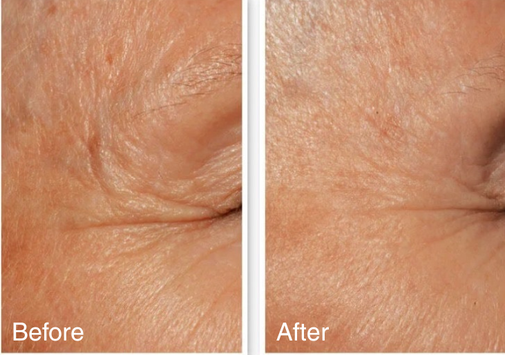 before and after skin improvement with LED face mask showing brighter and smoother-looking complexion