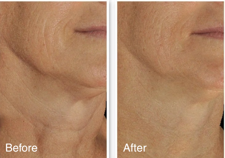 before and after LED face mask use on mature skin showing reduced appearance of fine lines and improved skin texture