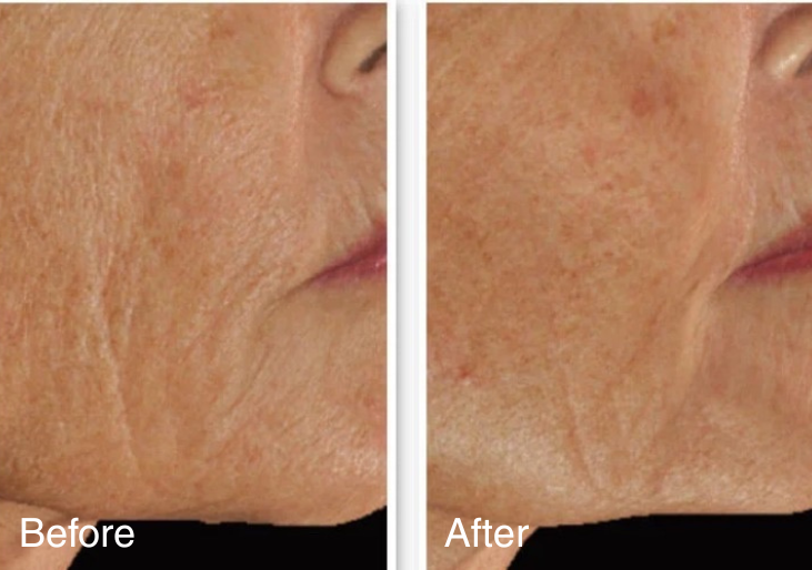 before and after LED face mask use on mature skin showing reduced appearance of fine lines and improved skin texture