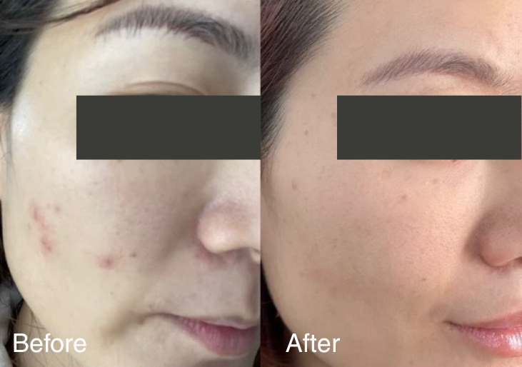 before and after LED face mask use showing brighter, smoother, and more even-looking skin